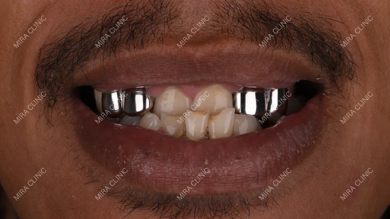 missing teeth